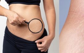 Stretch marks
