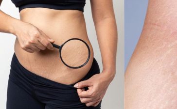 Stretch marks