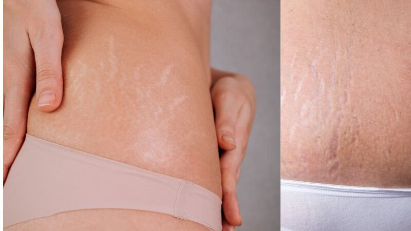 Stretch marks on body