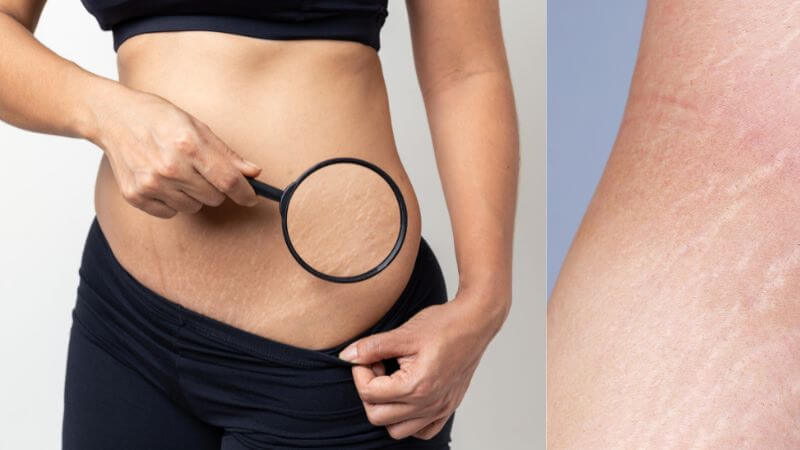 Stretch marks