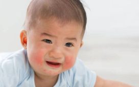 Baby Eczema Symptoms