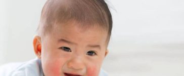 Baby Eczema Symptoms