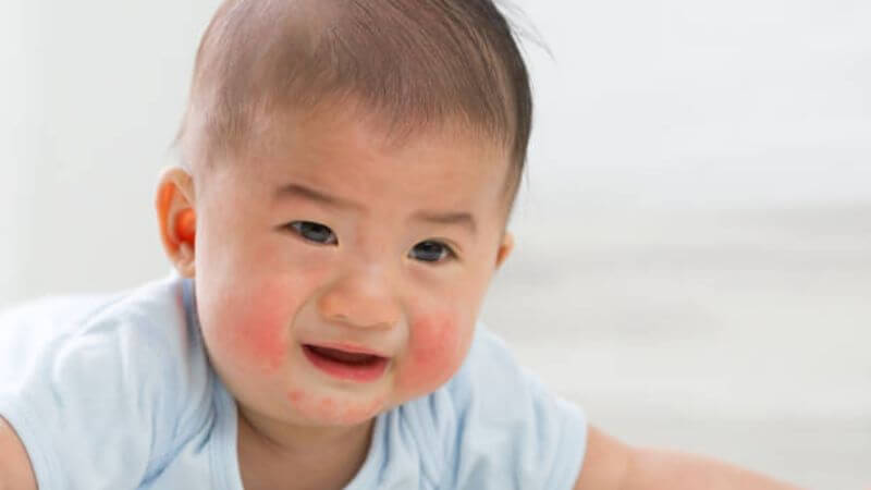 Baby Eczema Symptoms