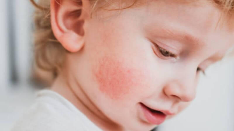 Baby Eczema Symptoms
