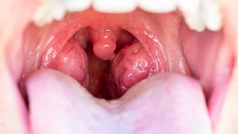 Swollen Tonsils