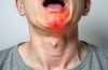 Swollen Tonsils