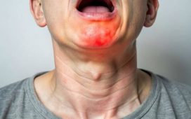 Swollen Tonsils