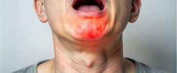 Swollen Tonsils