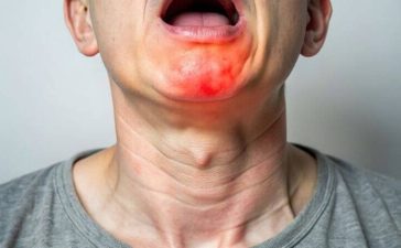 Swollen Tonsils