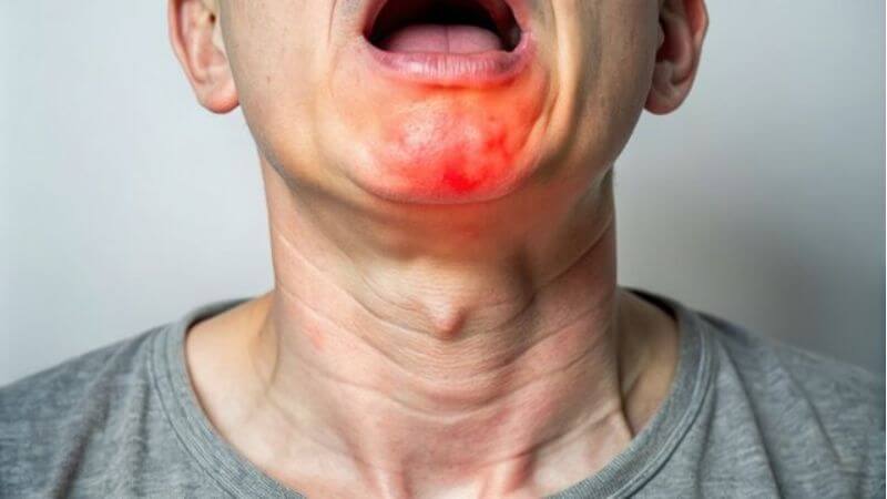 Swollen Tonsils