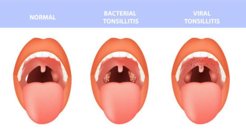 Swollen Tonsils