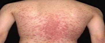 Pityriasis Rosea foods to avoid