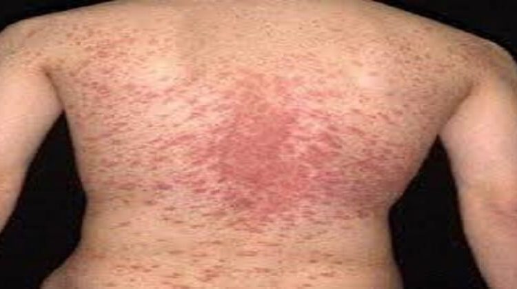 Pityriasis Rosea foods to avoid