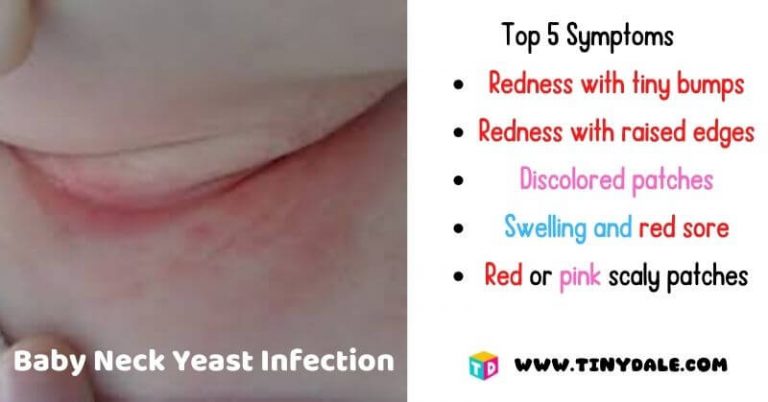 how-can-i-treat-baby-neck-yeast-infection