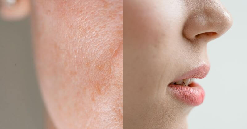 12 Proven Ways To Treat Enlarged Pore That Looks Like A Hole